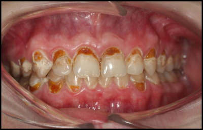 Clinical photograph of advanced cervical erosion