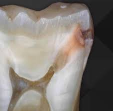Cross-section of a tooth showing an active lesion