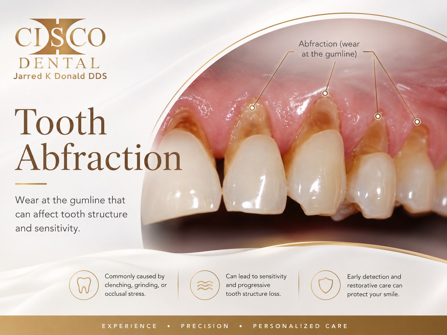 Tooth abfraction: wedge-shaped wear and erosion at the gumline of several upper teeth