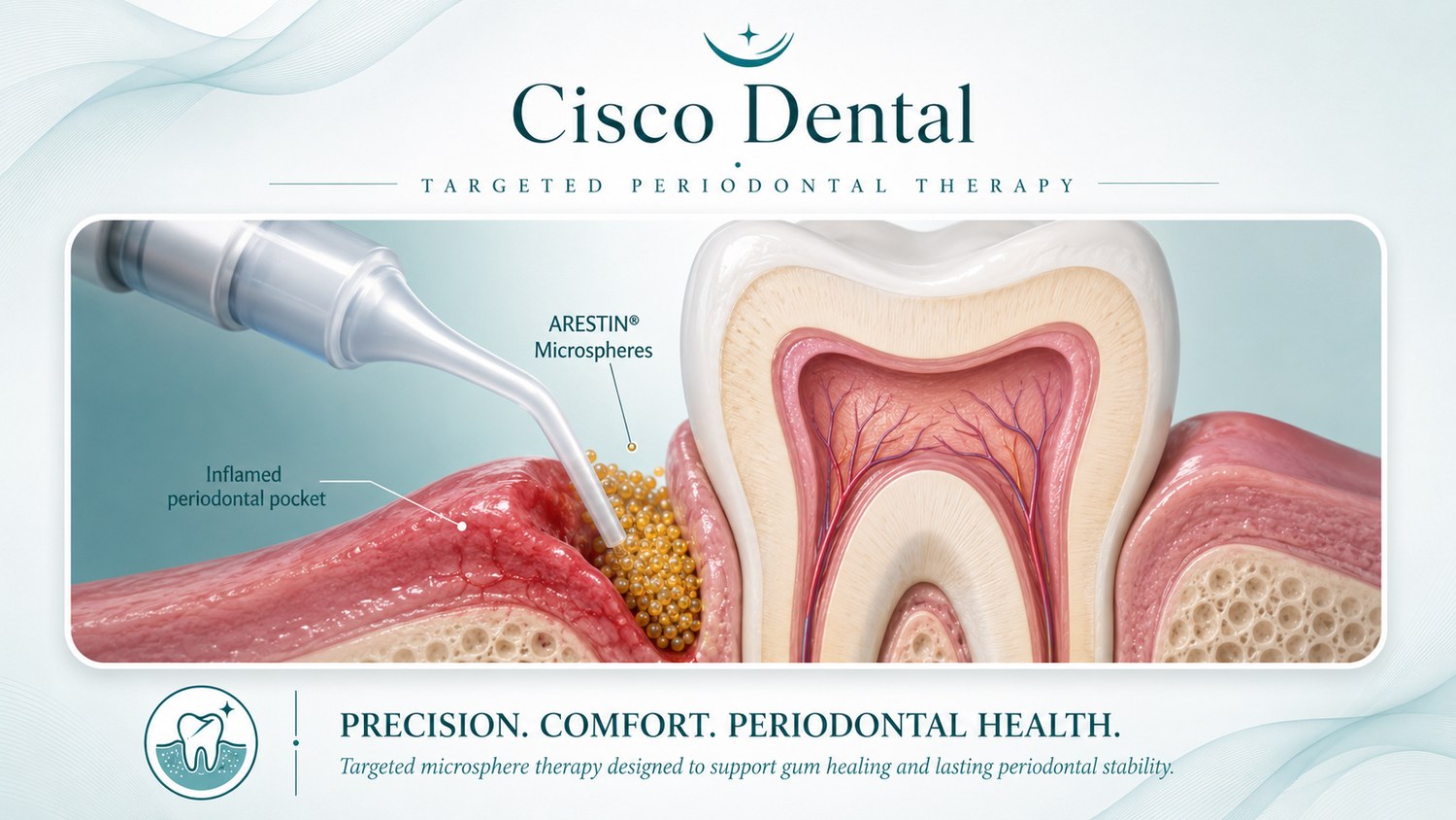 Cross-section illustration of Arestin antibiotic microspheres being placed into an inflamed periodontal pocket