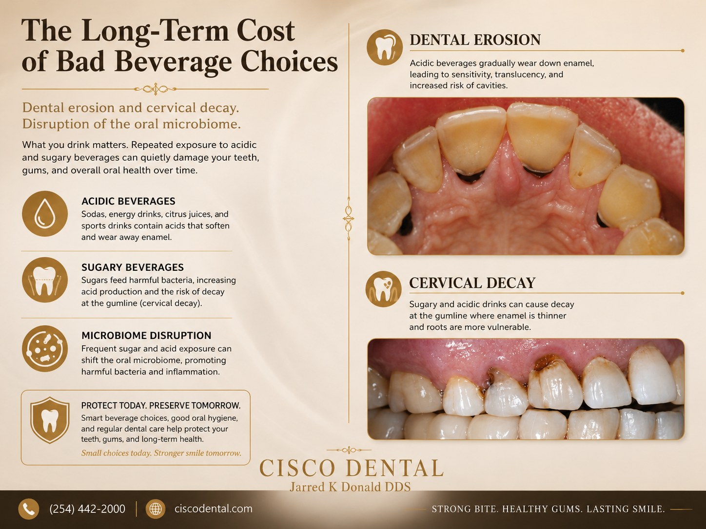 Educational graphic: dental erosion and cervical decay caused by acidic and sugary beverages, with clinical photos