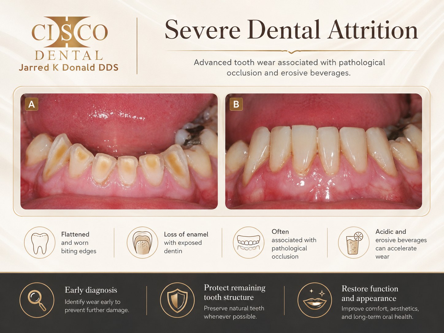 Severe dental attrition: lower front teeth worn flat with exposed dentin from grinding, shown before and after restoration