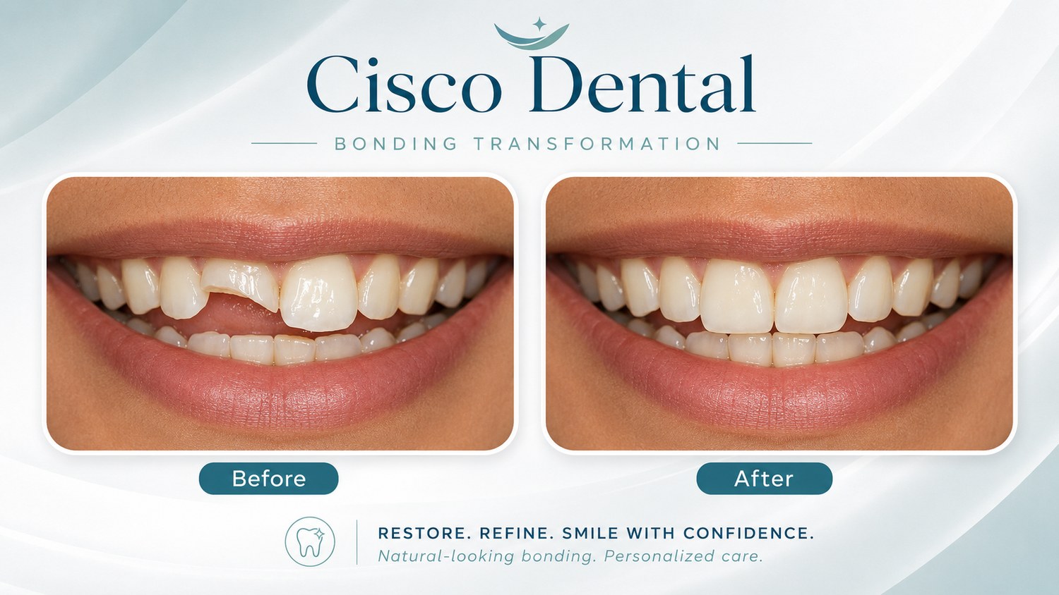 Before and after dental bonding: a chipped front tooth on the left, repaired and natural-looking on the right
