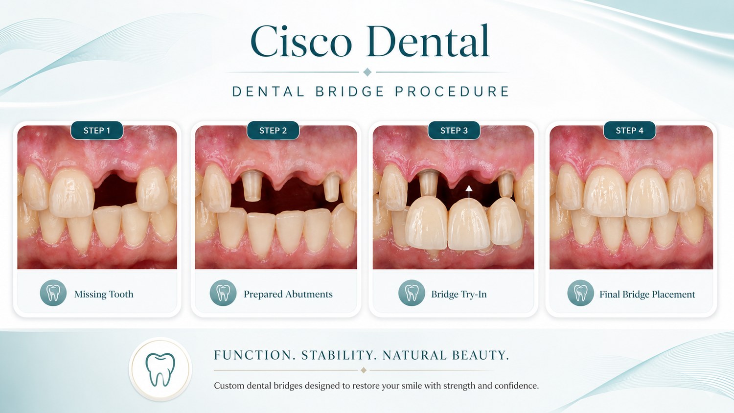Four-step photo series of a dental bridge: missing tooth, prepared abutments, bridge try-in, and final bridge placement