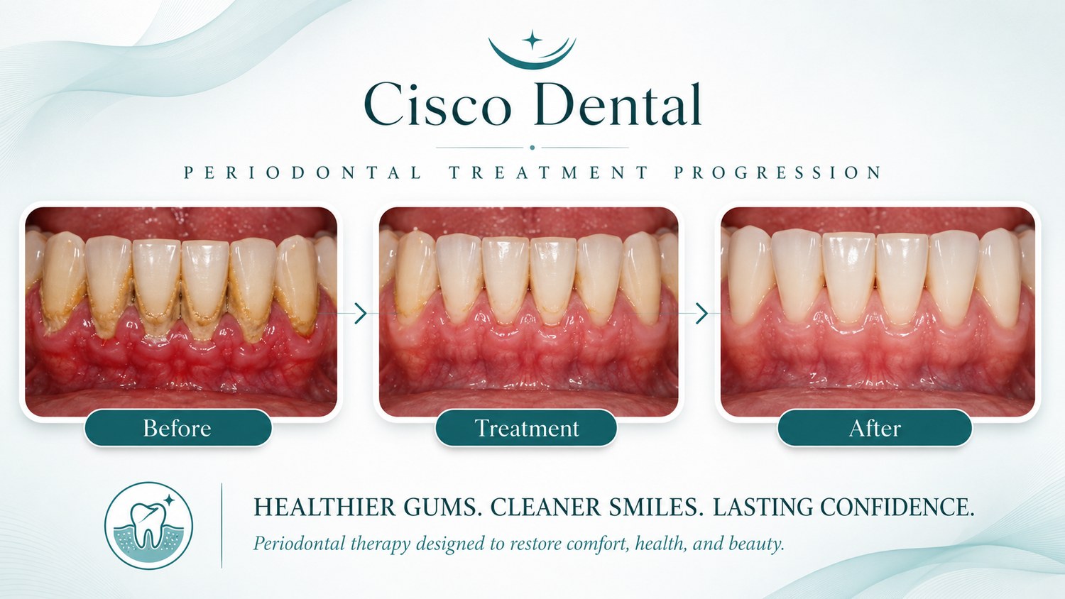 Periodontal treatment progression: inflamed, tartar-covered gums before treatment, then a healthier, more stable gumline after therapy