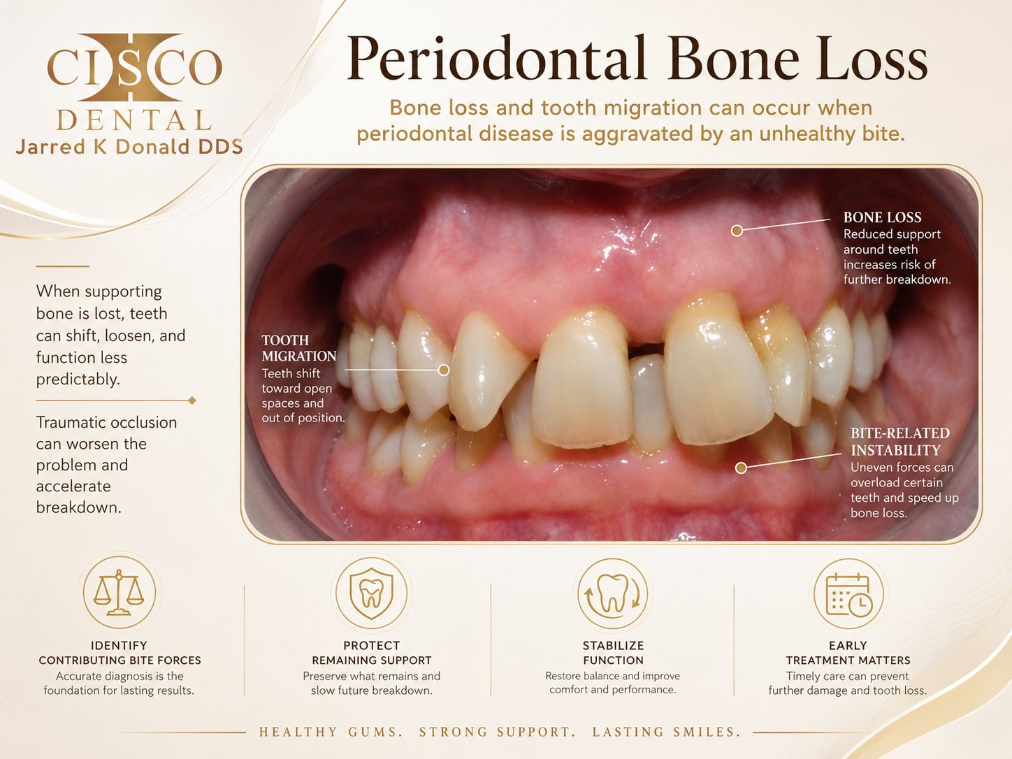 Periodontal bone loss and tooth migration: reduced bone support around teeth that have drifted and loosened