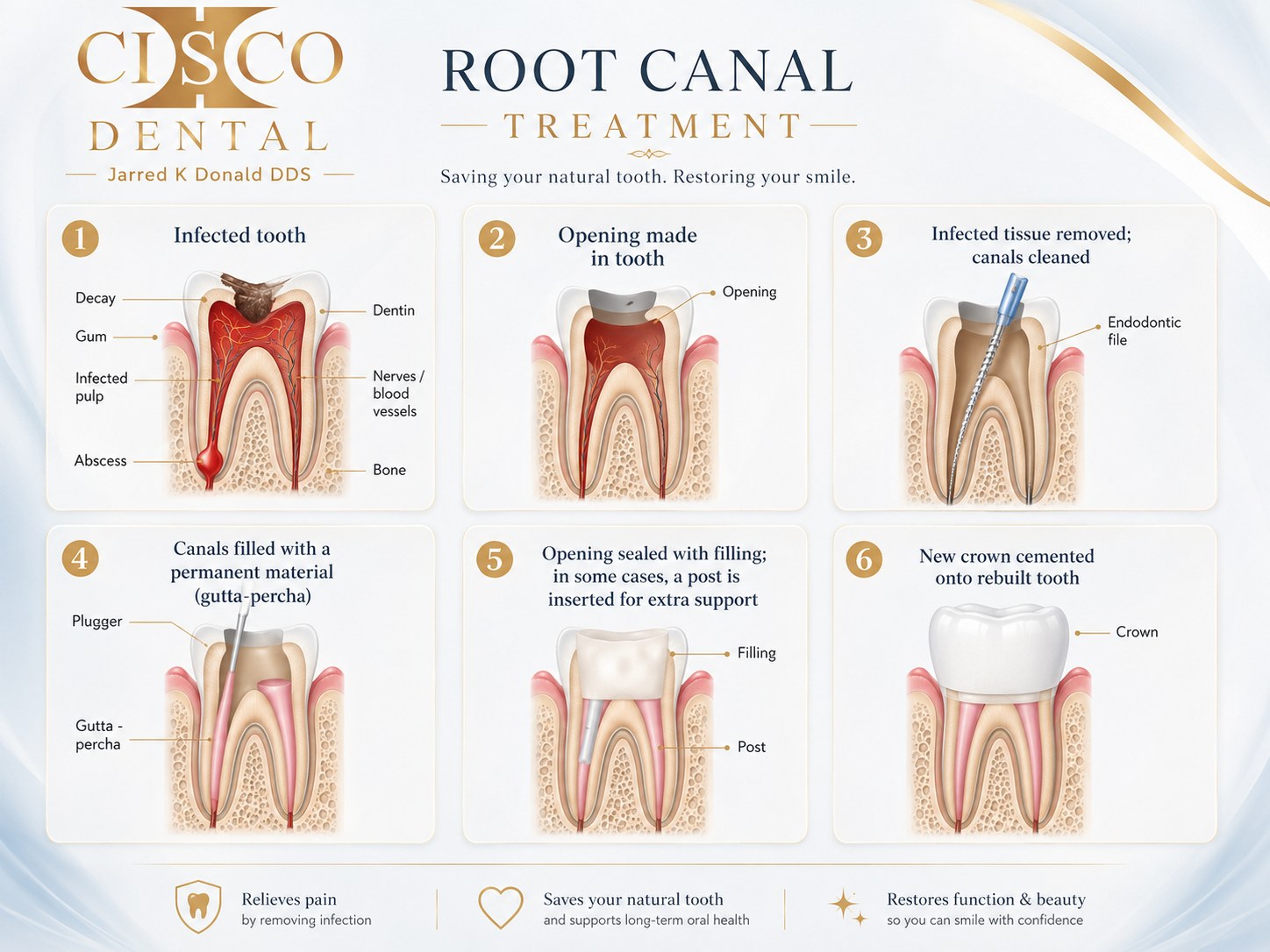 Six-step illustration of non-surgical root canal treatment, from an infected tooth to a cleaned, sealed, and crowned tooth