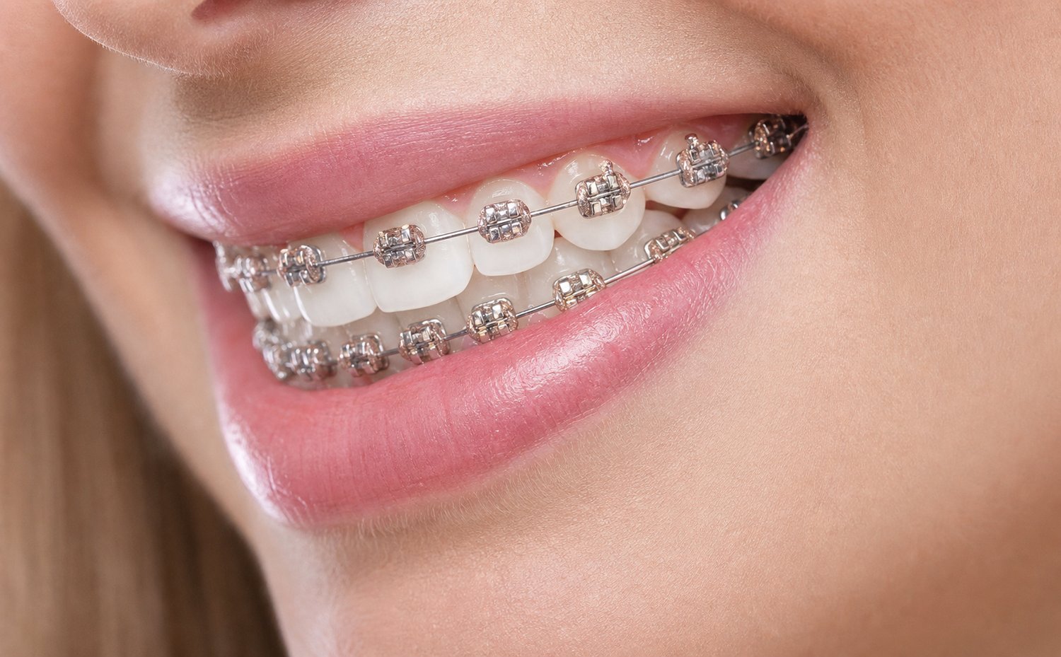 Traditional metal braces on a smile