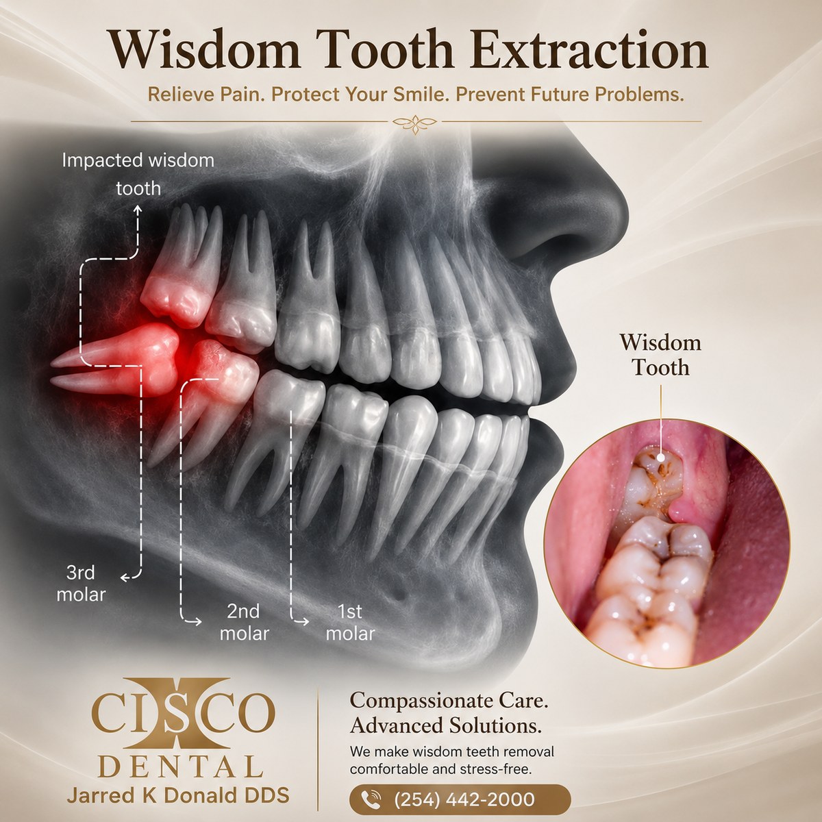 An X-ray-style illustration of an impacted wisdom tooth angled against the second molar, with a clinical photo of the same tooth
